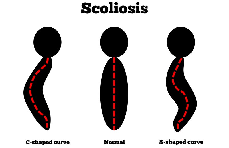 Haverhill, MA scoliosis treatment